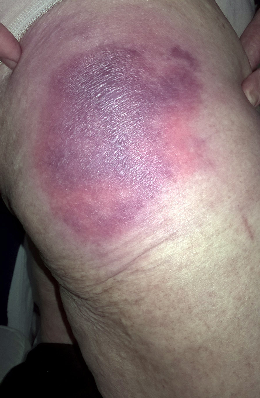 Bloeduitstortin hardnekkig blauwe plekkeng supplementen nodig